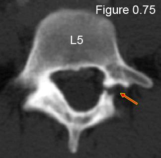 unilateral spondylolysis