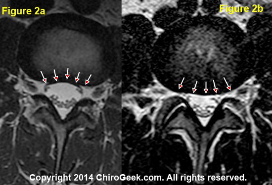 disc bulge MRI