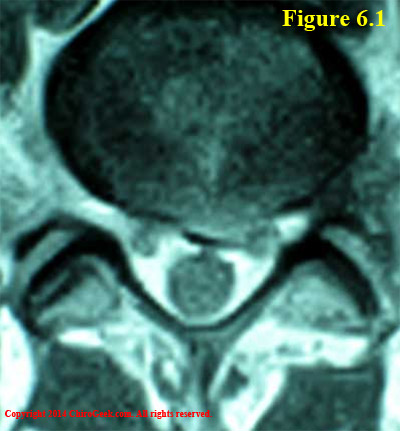 My disc herniation