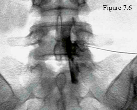 Lower lumbar epidural steroid injection side effects