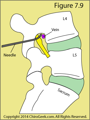 Lumbar transforaminal epidural steroid injection technique