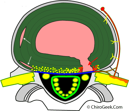 grade 3 annular tear