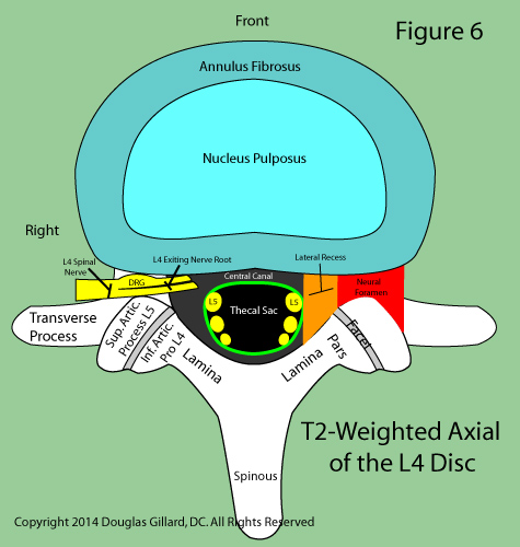 Slipped Disc Mabuhay Chiropractic Clinics