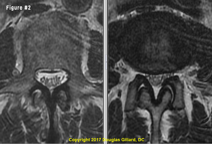 spinal stenosis analysis example