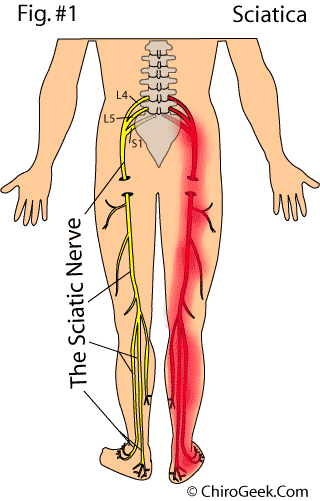 Sciatica and Sciatic Nerve Pain