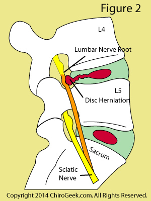 disc-herniation related sciatica