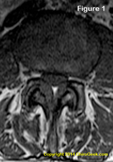 Spinal stenosis Information