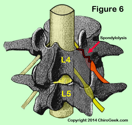 lateral stenosis via pars defect