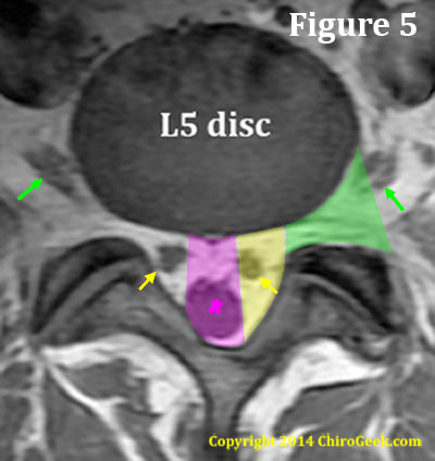 The nerve root canals of the L5/S1 motion segment