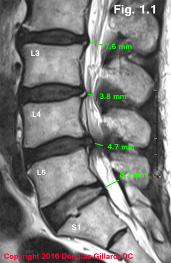 Spinal Stenosis Injections: Never Trust a Back MRI! - Wasatch Pain Solutions