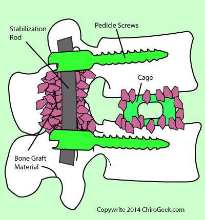 lumbar interbody fusion